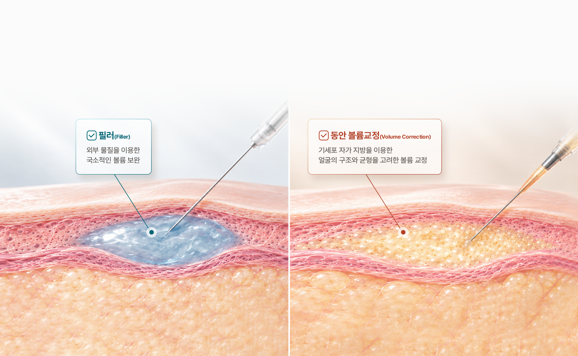 필러는 외부 물질로 국소적인 볼륨을 보완하고, 동안 볼륨교정은 자가 줄기세포 지방으로 얼굴의 구조와 균형을 고려해 교정합니다.
