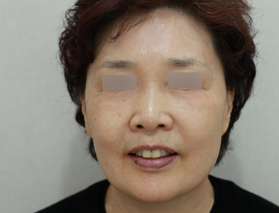 시술 후 3개월 경과한 얼굴 볼륨 상태 사진