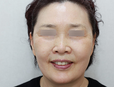 시술 후 6개월 경과한 얼굴 볼륨 상태 사진