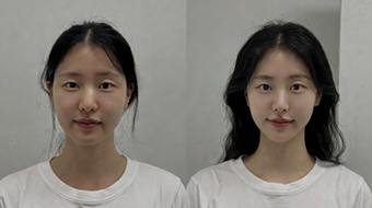 치료 전후 비교