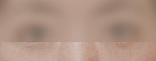 시술 후 개선된 눈가 상태 사진