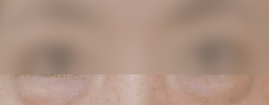 시술 전 눈가 상태 사진